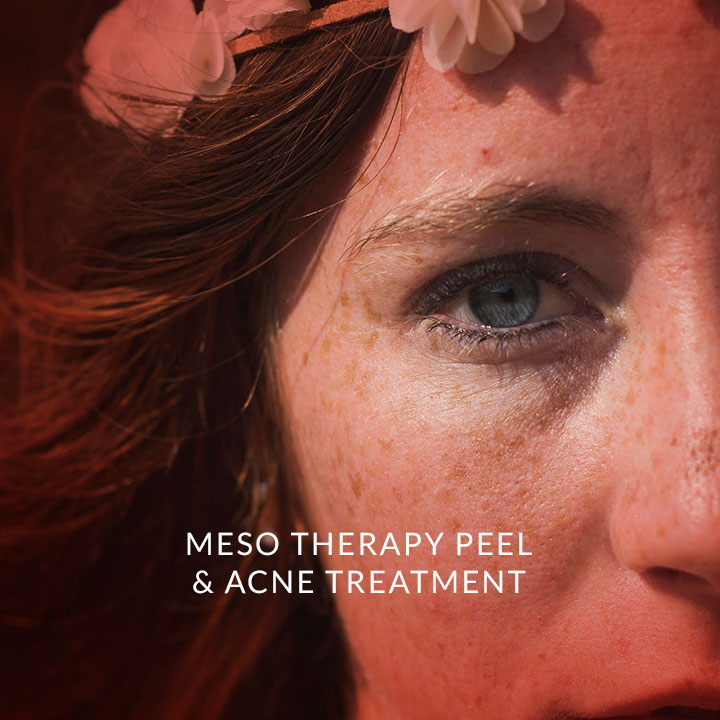 mesotherapy-peel-and-acne-treatment